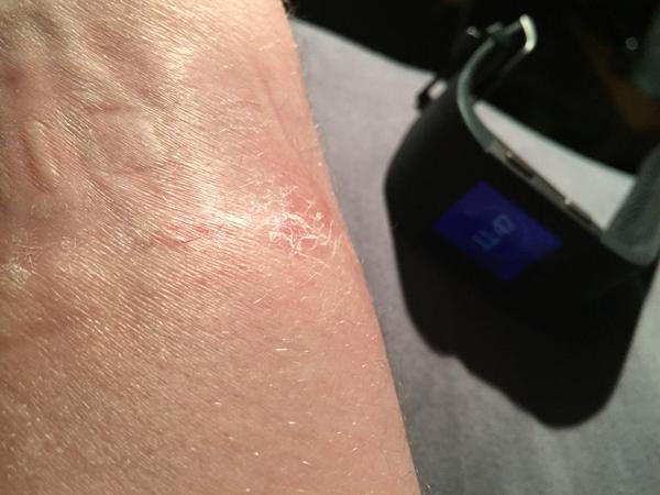 fitbit charge 3 burning wrist