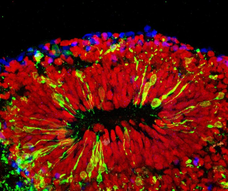 A "mini-brain" infected with Zika. The red-dye indicates vulnerable progenitor cells.