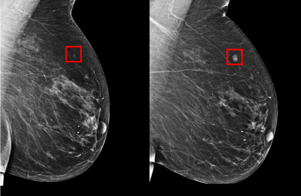 MIT AI tool can predict breast cancer up to 5 years early, works equally well for white and black patients